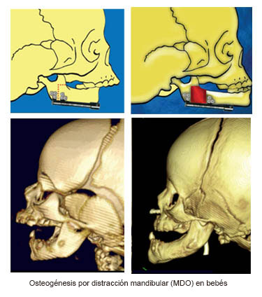 https://bebeboxer.store/SiteCollectionImages/Infant_Mandibular_Distraction_Osteogenesis_es.jpg