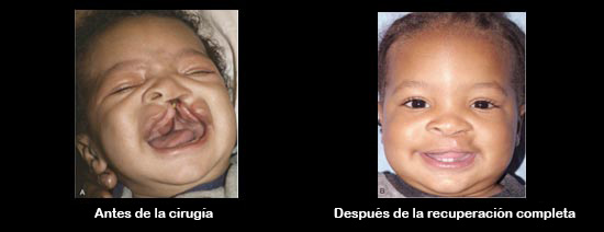 https://bebeboxer.store/SiteCollectionImagesArticleImages/CleftbeforeAfter_Baby_es.jpg
