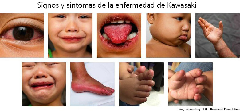 https://bebeboxer.store/SiteCollectionImagesArticleImages/Signs_Symptoms_Kawasaki_Disease_es.jpg