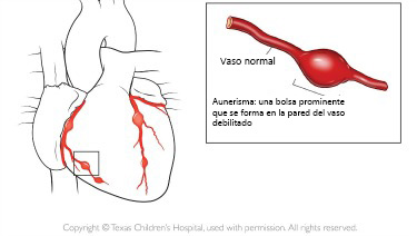 https://bebeboxer.store/SiteCollectionImagesArticleImages/aneurysm_texaschildrens_es.jpg