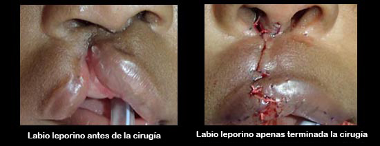 https://bebeboxer.store/SiteCollectionImagesArticleImages/cleftLipBeforeAfter2_es.jpg
